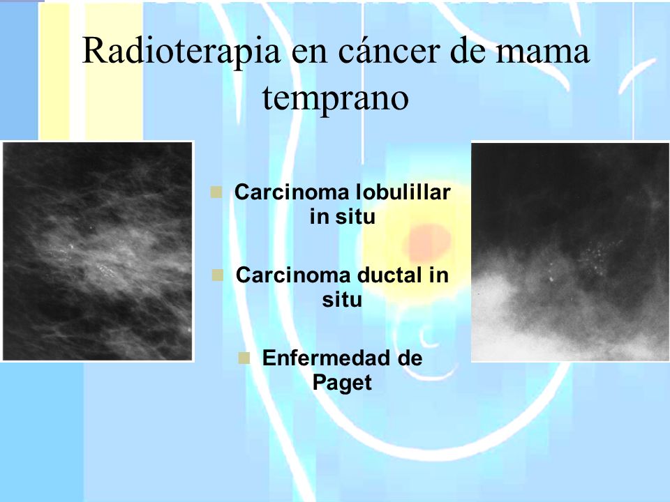 Radioterapia en cáncer de mama temprano
