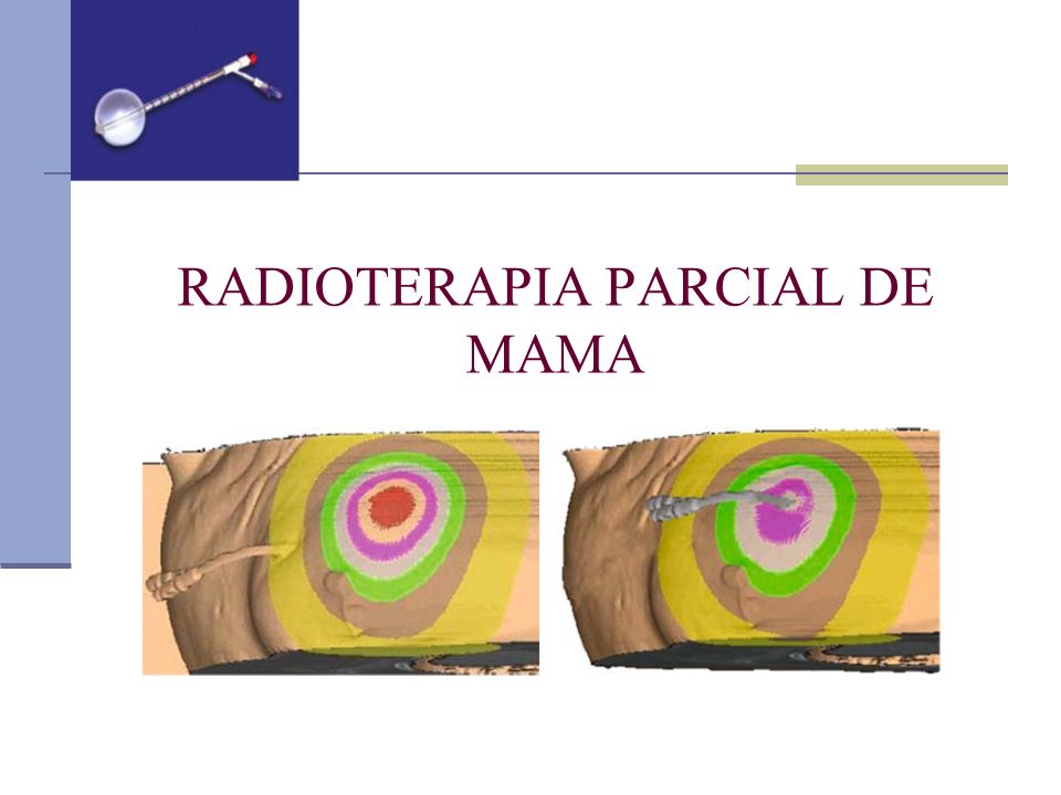 RADIOTERAPIA PARCIAL DE MAMA