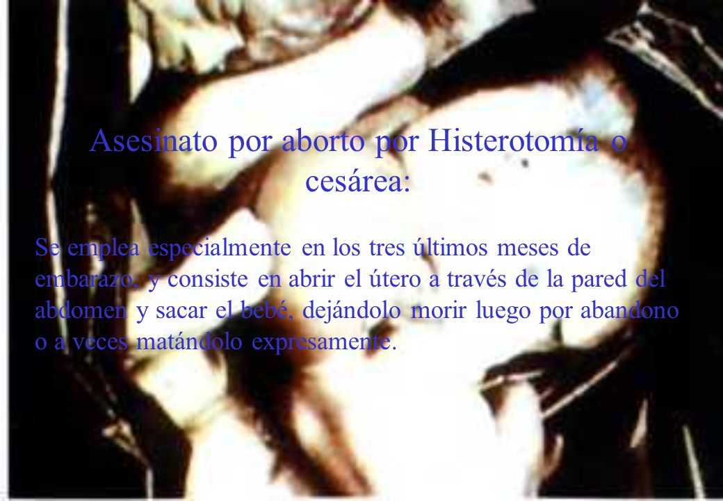 Asesinato por aborto por Histerotomía o cesárea: