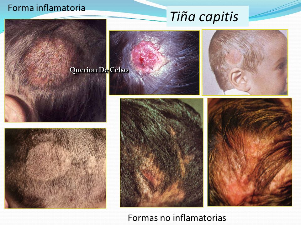 Tiña capitis Forma inflamatoria Formas no inflamatorias