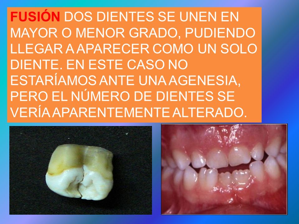 FUSIÓN DOS DIENTES SE UNEN EN MAYOR O MENOR GRADO, PUDIENDO LLEGAR A APARECER COMO UN SOLO DIENTE.
