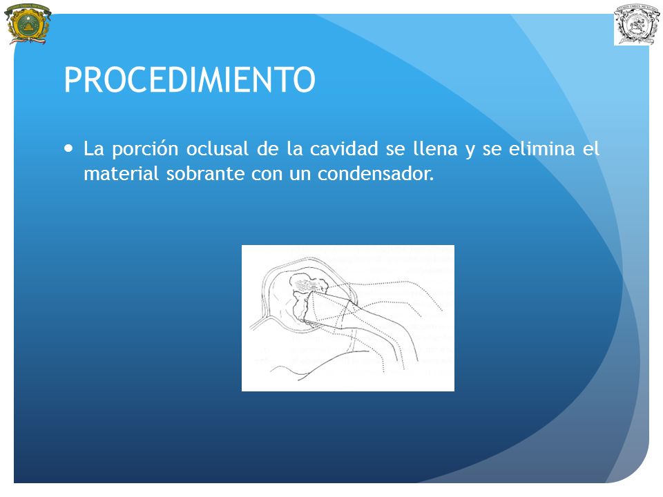 PROCEDIMIENTO La porción oclusal de la cavidad se llena y se elimina el material sobrante con un condensador.