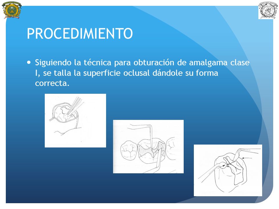 PROCEDIMIENTO Siguiendo la técnica para obturación de amalgama clase I, se talla la superficie oclusal dándole su forma correcta.
