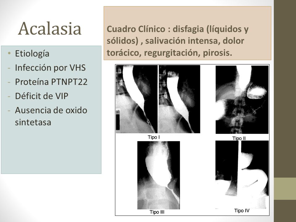 Cuadro Clínico : disfagia (líquidos y sólidos) , salivación intensa, dolor torácico, regurgitación, pirosis.