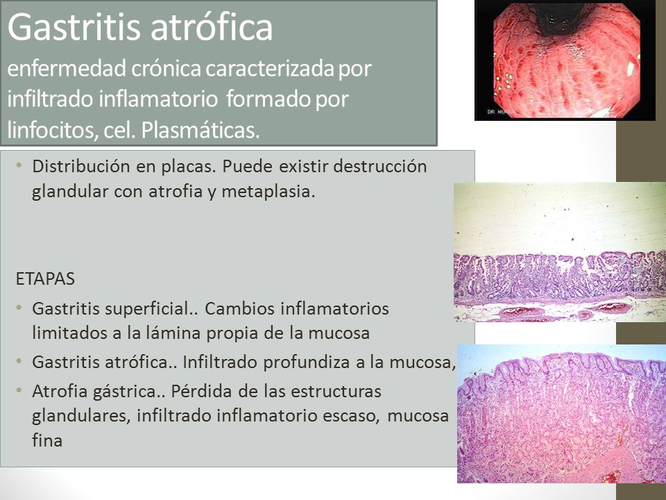 Gastritis atrófica enfermedad crónica caracterizada por infiltrado inflamatorio formado por linfocitos, cel. Plasmáticas.