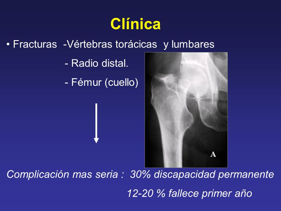 Clínica Fracturas -Vértebras torácicas y lumbares - Radio distal.