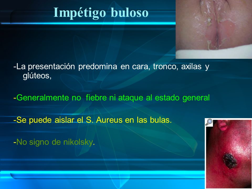 Impétigo buloso -La presentación predomina en cara, tronco, axilas y glúteos, -Generalmente no fiebre ni ataque al estado general.