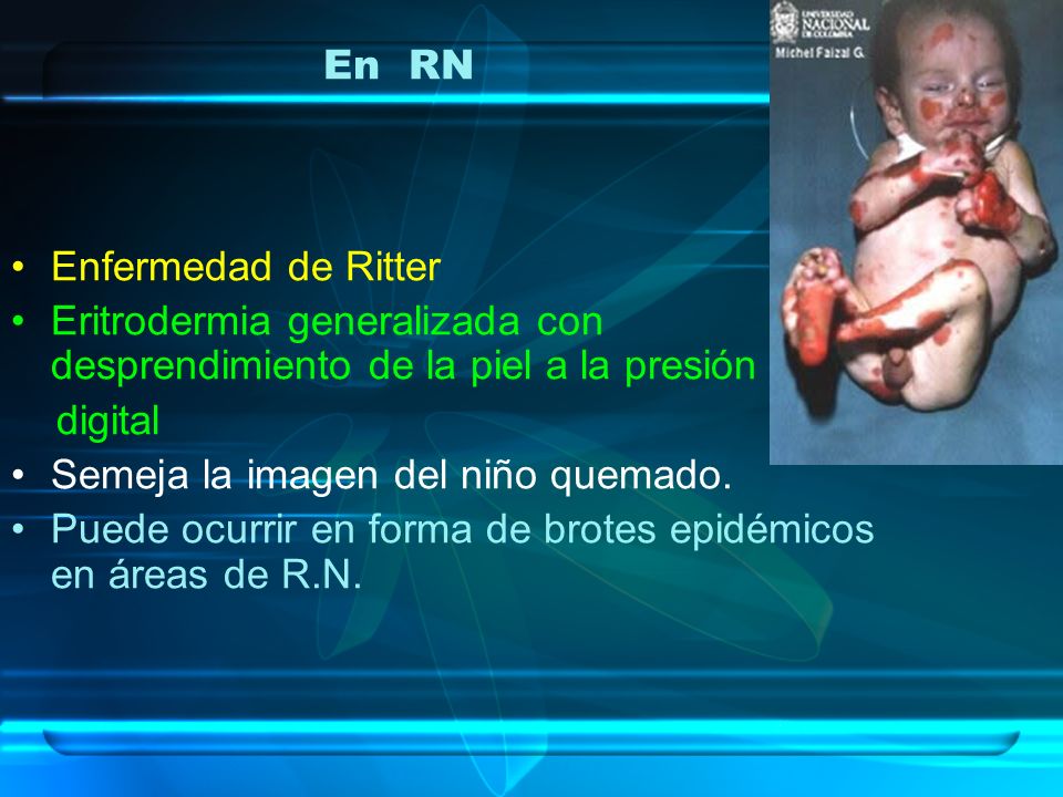 En RN Enfermedad de Ritter. Eritrodermia generalizada con desprendimiento de la piel a la presión.