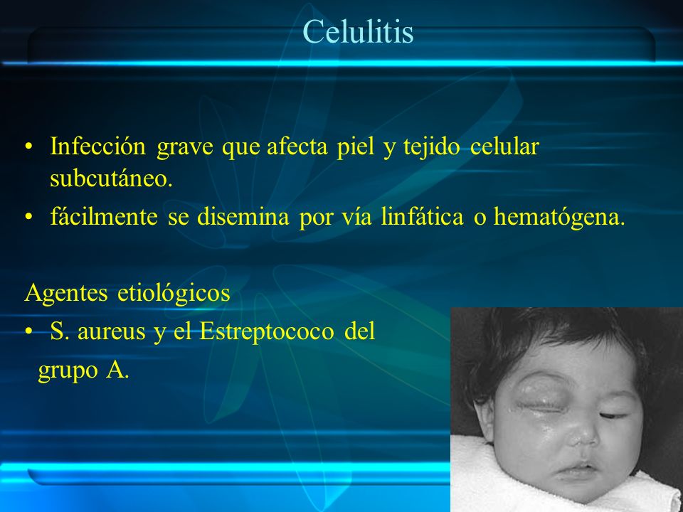 Celulitis Infección grave que afecta piel y tejido celular subcutáneo.