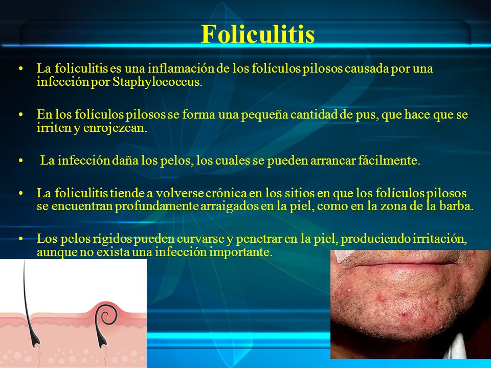 Foliculitis La foliculitis es una inflamación de los folículos pilosos causada por una infección por Staphylococcus.