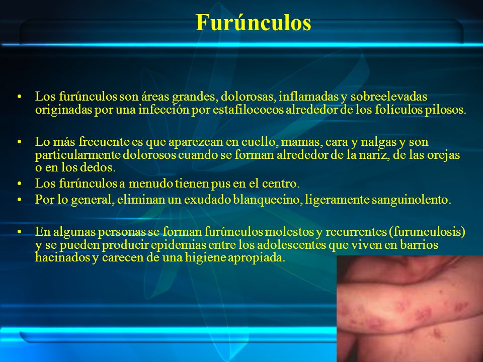 Furúnculos