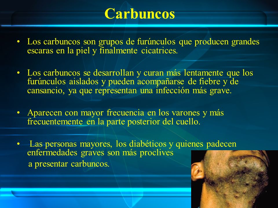 Carbuncos Los carbuncos son grupos de furúnculos que producen grandes escaras en la piel y finalmente cicatrices.