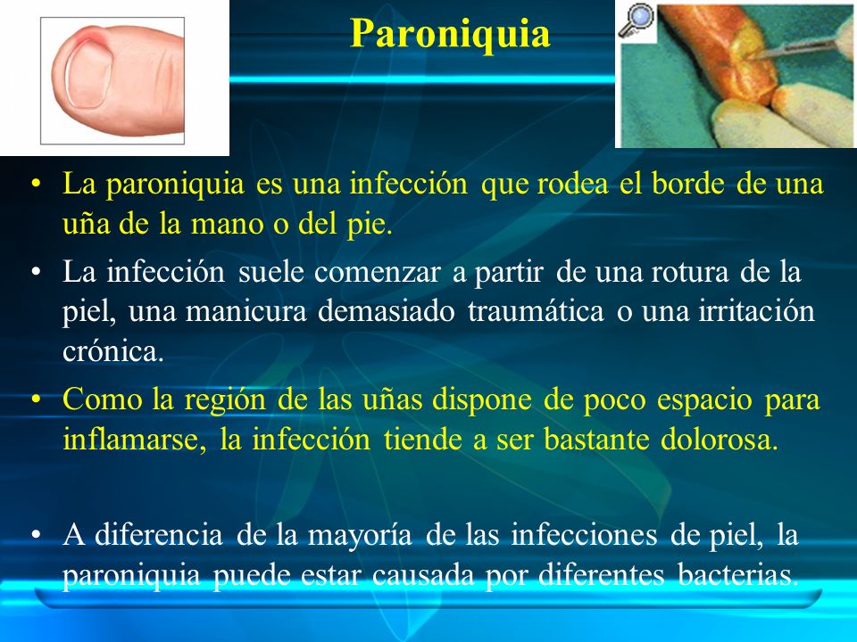 Paroniquia La paroniquia es una infección que rodea el borde de una uña de la mano o del pie.