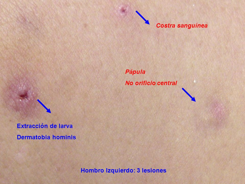Costra sanguínea Pápula. No orificio central. Extracción de larva.