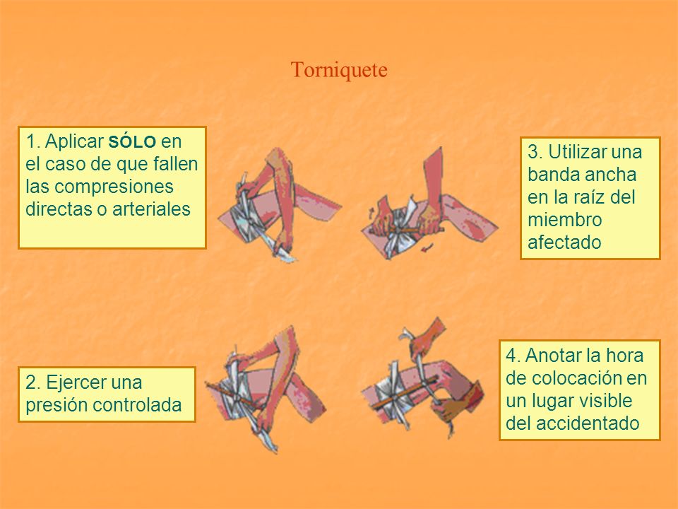 Torniquete 1. Aplicar SÓLO en el caso de que fallen las compresiones directas o arteriales.