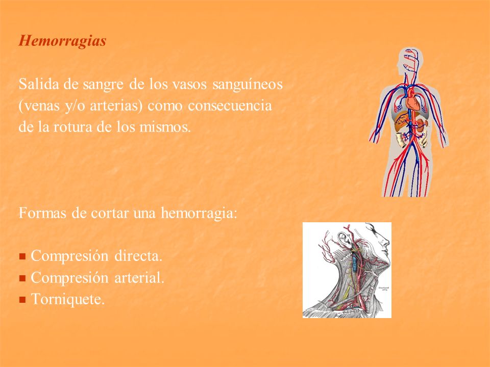 Hemorragias Salida de sangre de los vasos sanguíneos. (venas y/o arterias) como consecuencia. de la rotura de los mismos.