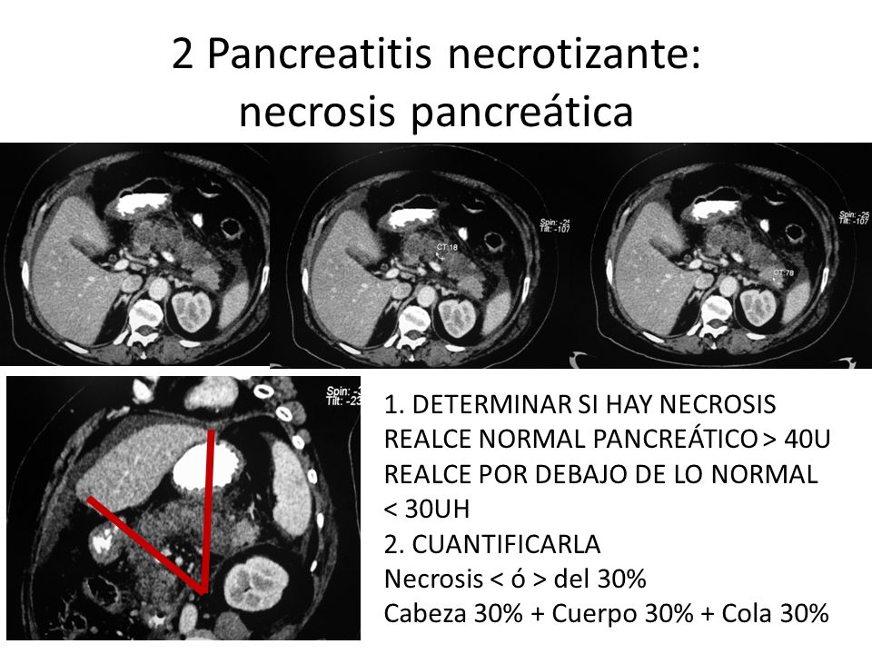 2 Pancreatitis necrotizante: necrosis pancreática