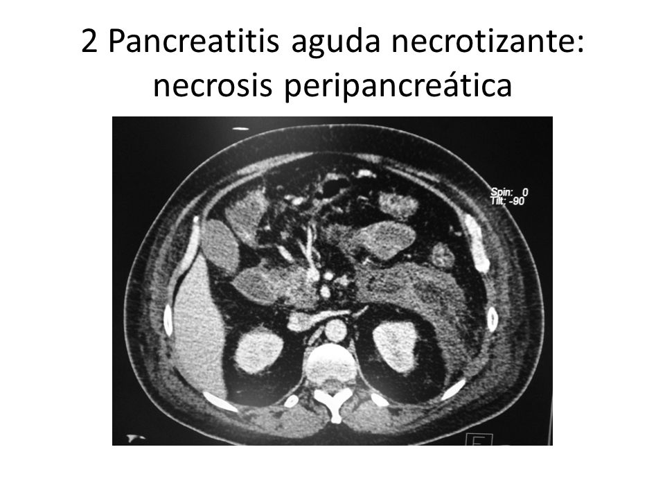 2 Pancreatitis aguda necrotizante: necrosis peripancreática