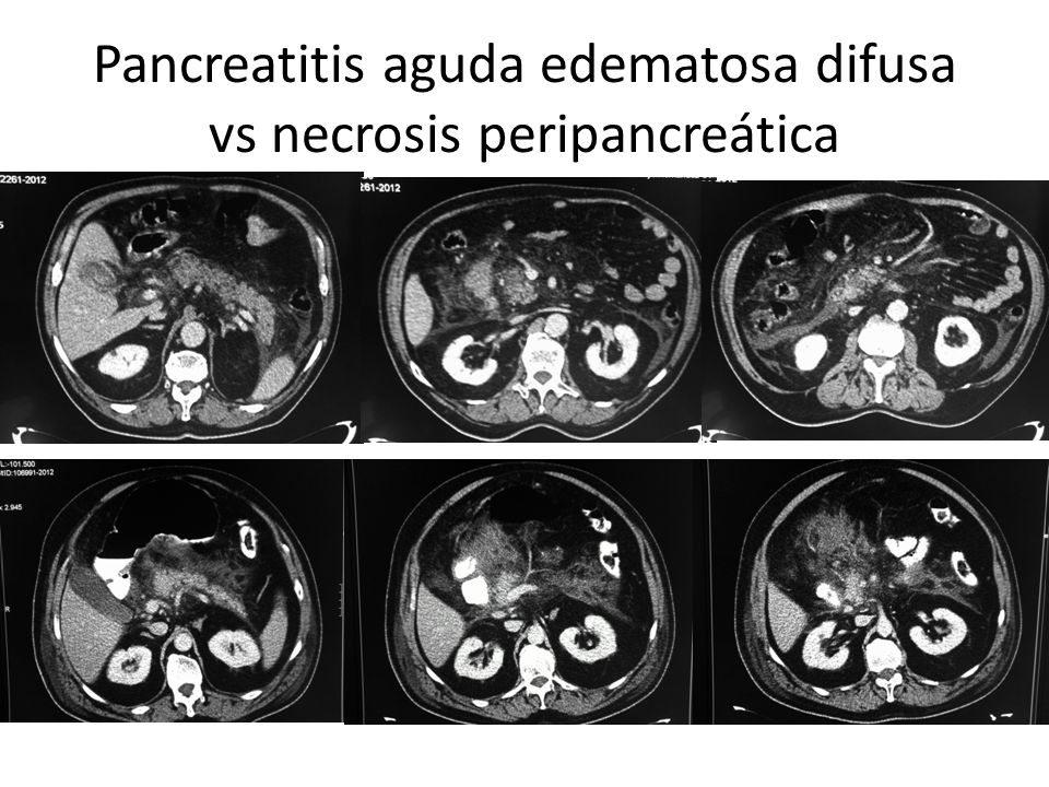 Pancreatitis aguda edematosa difusa vs necrosis peripancreática