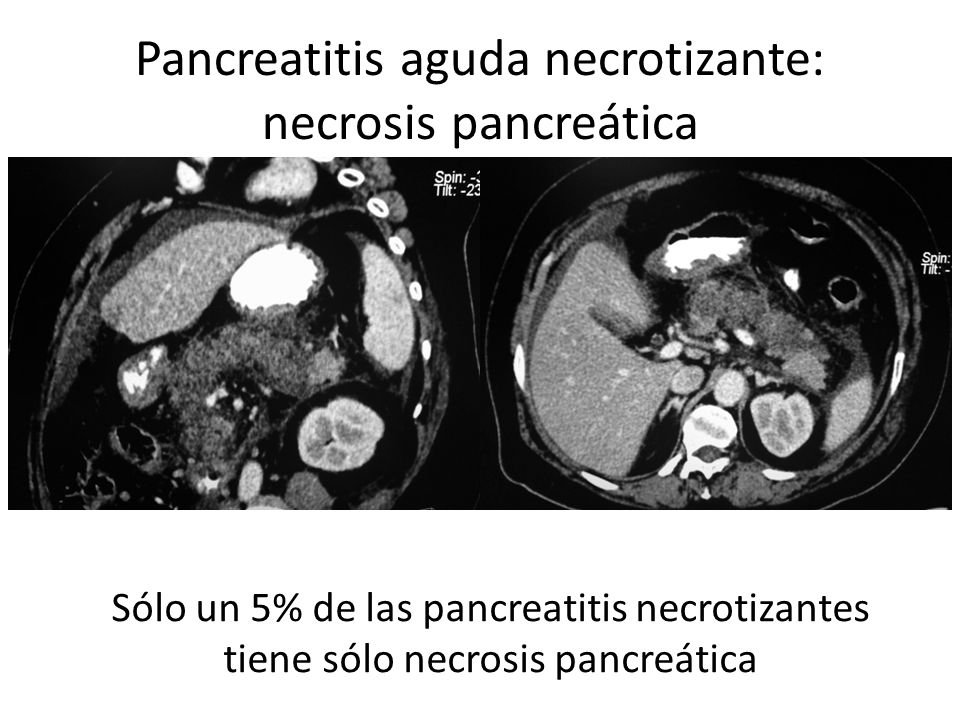 Pancreatitis aguda necrotizante: necrosis pancreática