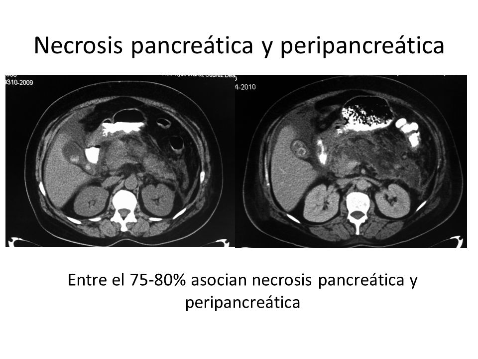 Necrosis pancreática y peripancreática