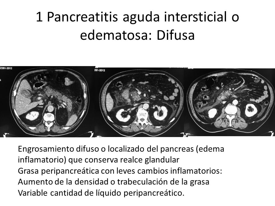 1 Pancreatitis aguda intersticial o edematosa: Difusa
