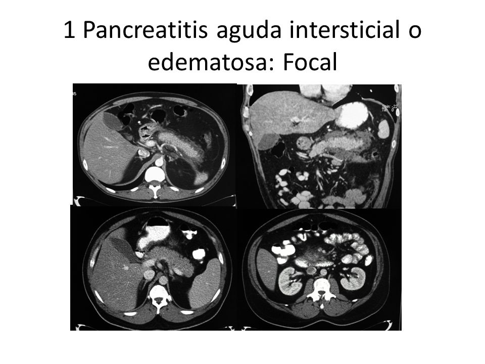 1 Pancreatitis aguda intersticial o edematosa: Focal