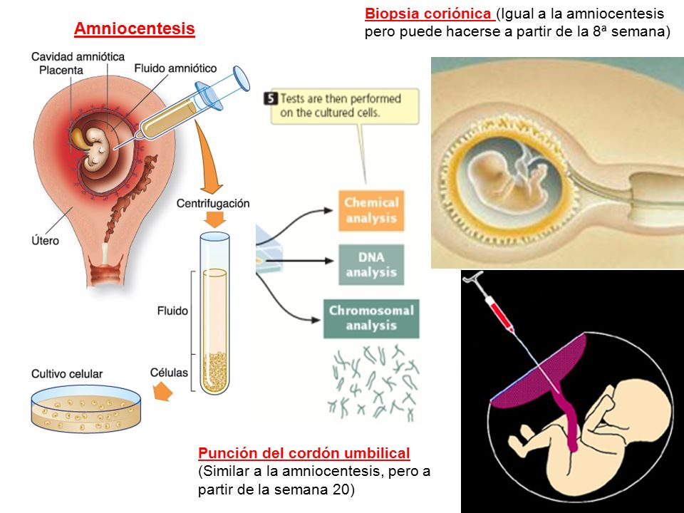 Biopsia coriónica (Igual a la amniocentesis pero puede hacerse a partir de la 8ª semana)