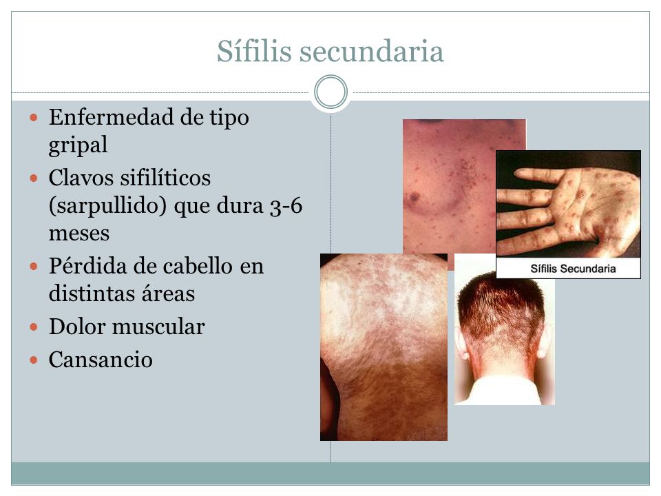 Sífilis secundaria Enfermedad de tipo gripal