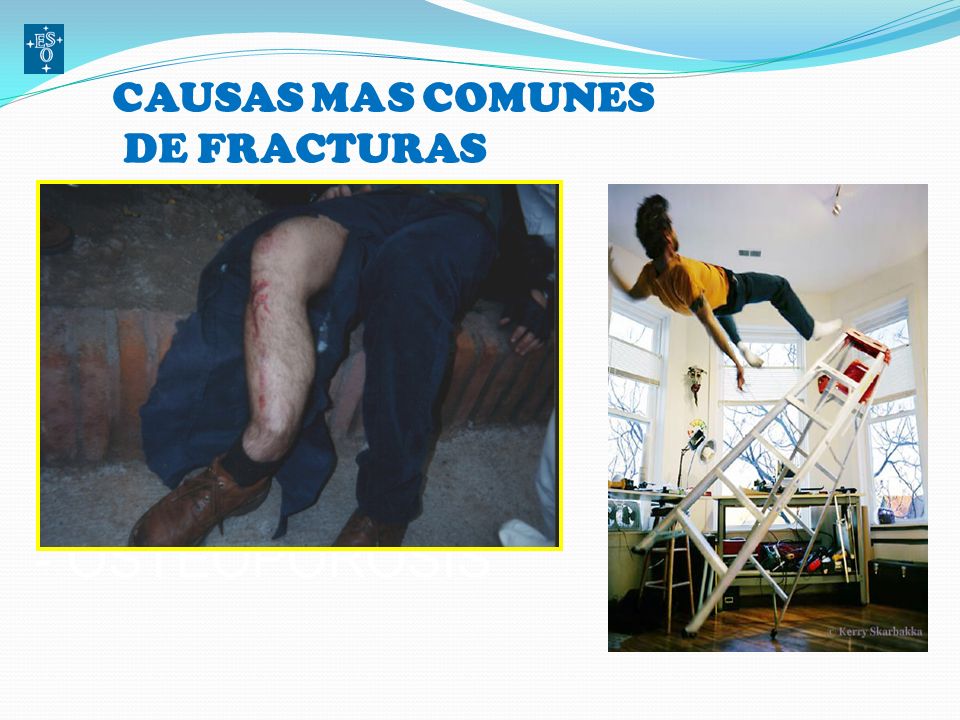 CAUSAS MAS COMUNES DE FRACTURAS