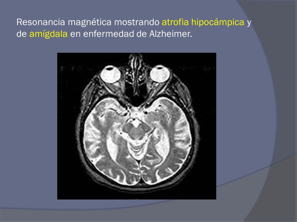 Resonancia magnética mostrando atrofia hipocámpica y de amígdala en enfermedad de Alzheimer.
