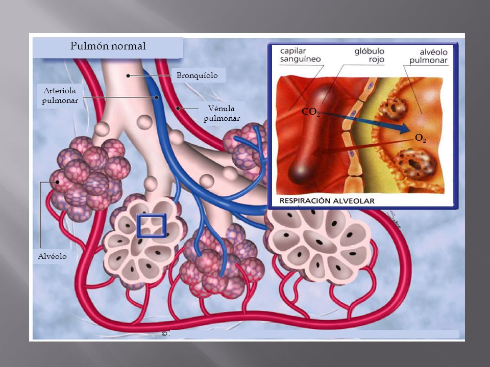 Pulmón normal CO2 O2 Bronquíolo Arteriola pulmonar Vénula pulmonar