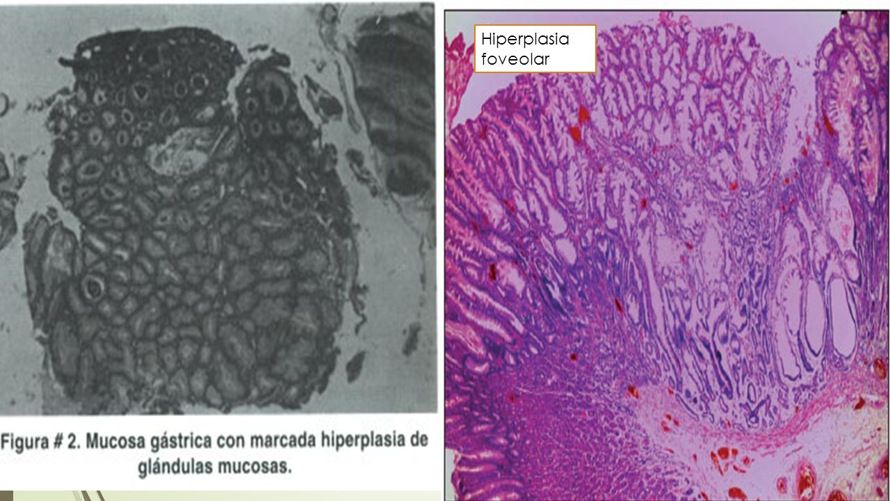 Hiperplasia foveolar