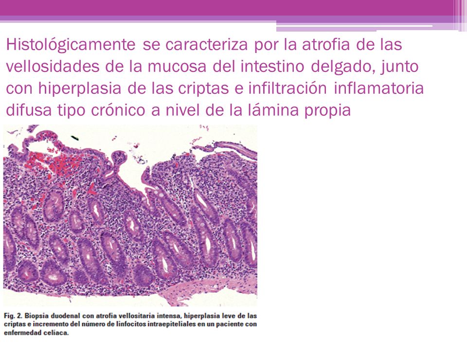 Histológicamente se caracteriza por la atrofia de las vellosidades de la mucosa del intestino delgado, junto con hiperplasia de las criptas e infiltración inflamatoria difusa tipo crónico a nivel de la lámina propia intestinal