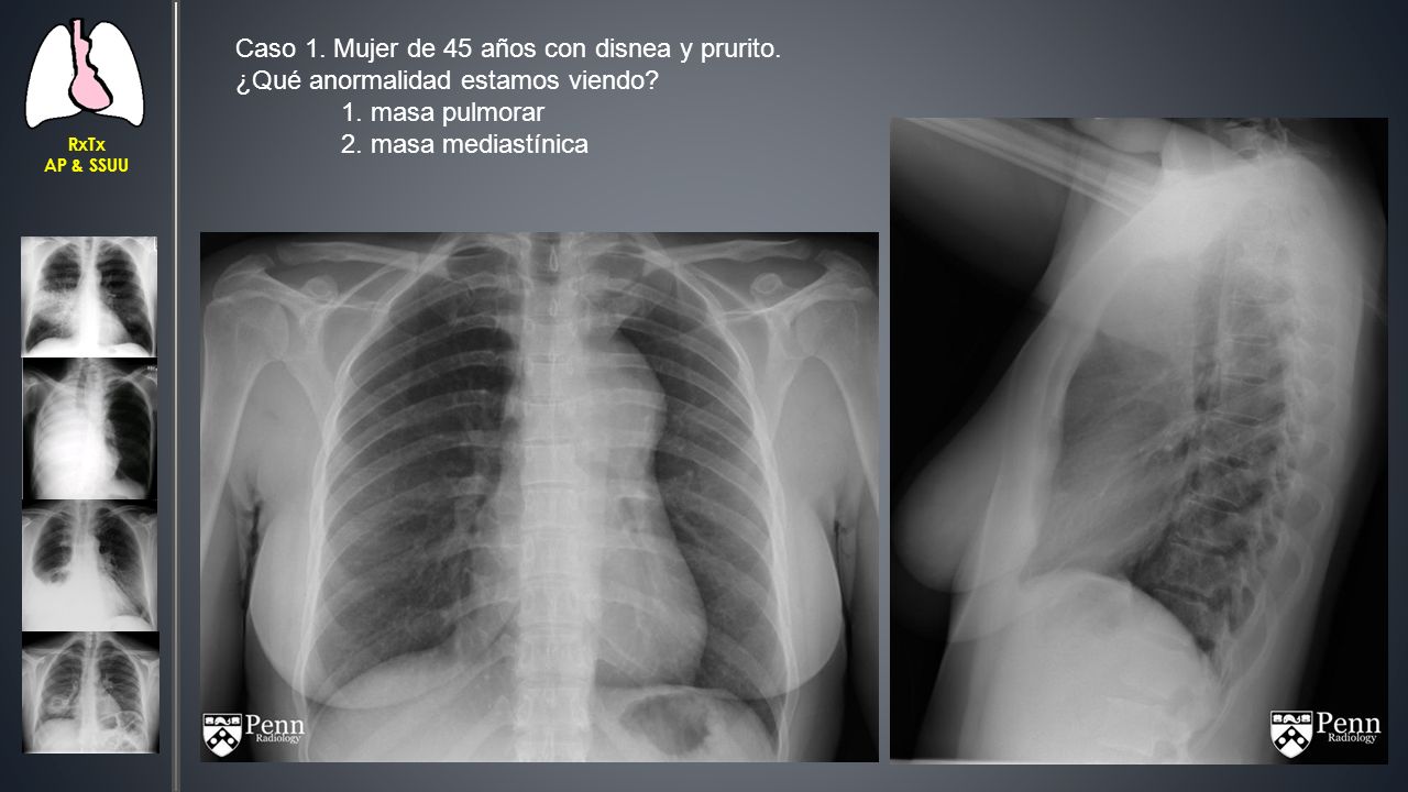Caso 1. Mujer de 45 años con disnea y prurito.