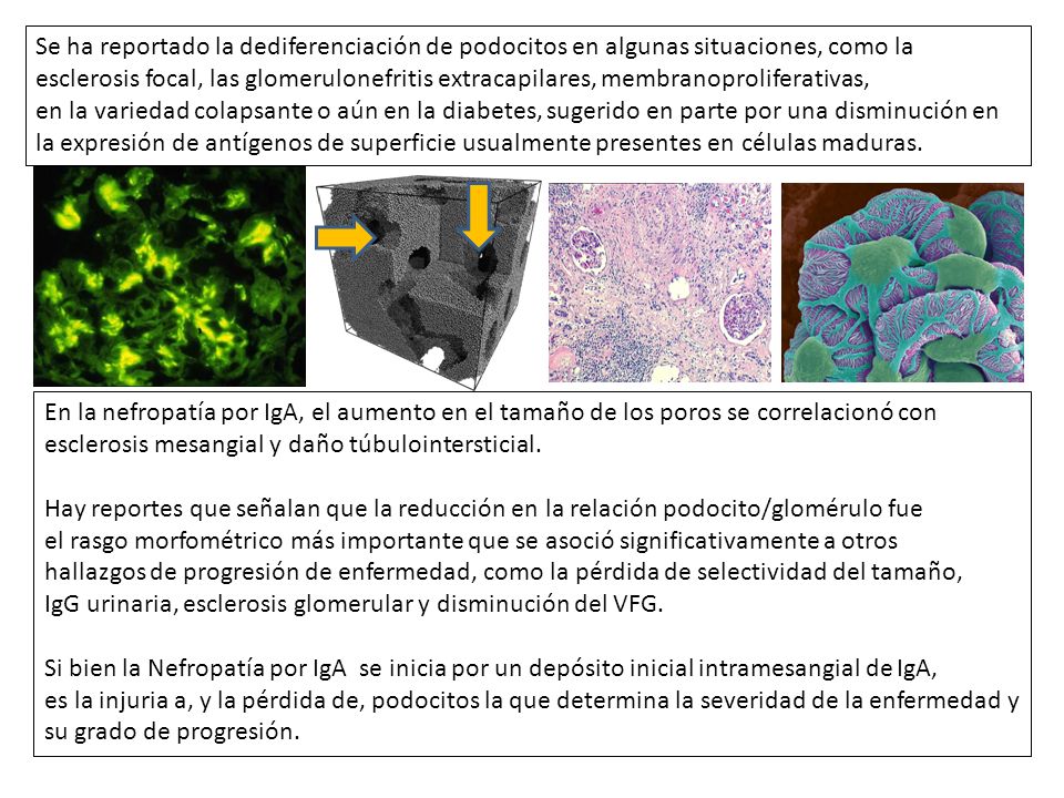 Se ha reportado la dediferenciación de podocitos en algunas situaciones, como la