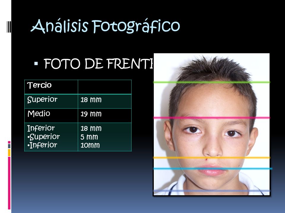 Análisis Fotográfico FOTO DE FRENTE Tercio Superior 18 mm Medio 19 mm