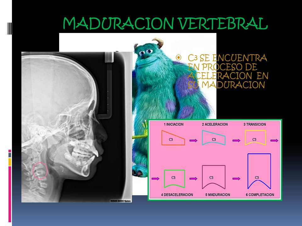 MADURACION VERTEBRAL C3 SE ENCUENTRA EN PROCESO DE ACELERACION EN SU MADURACION