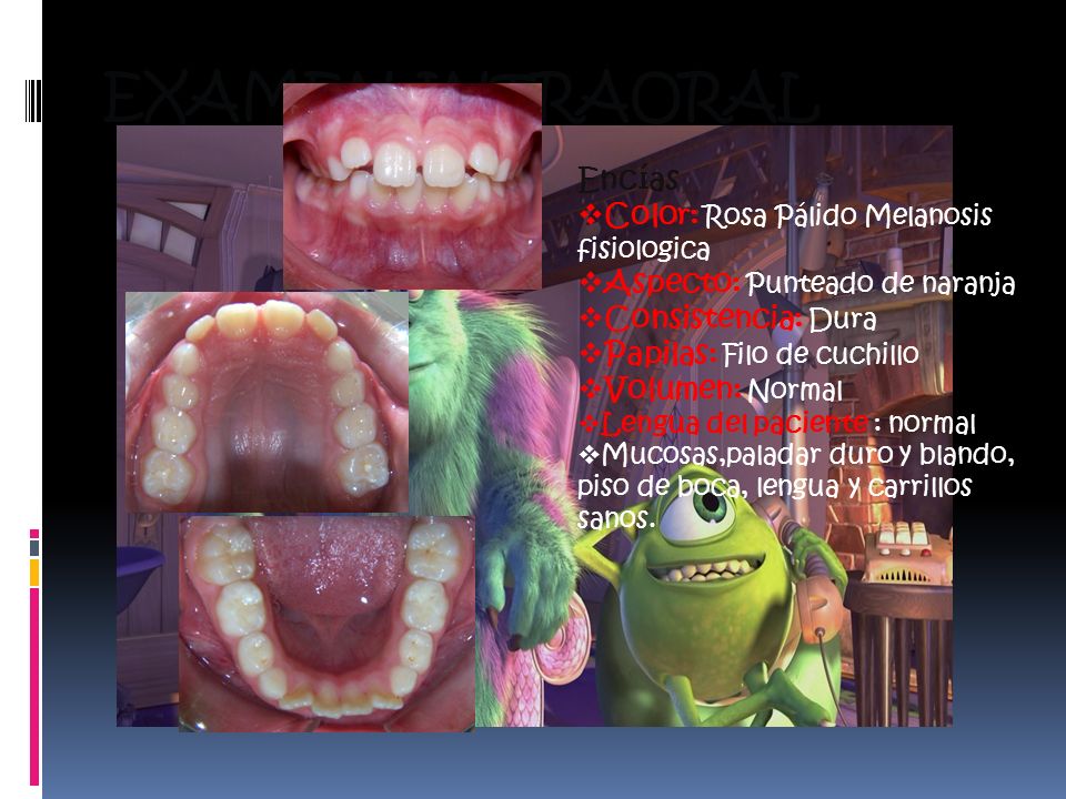 EXAMEN INTRAORAL Encías Color: Rosa Pálido Melanosis fisiologica