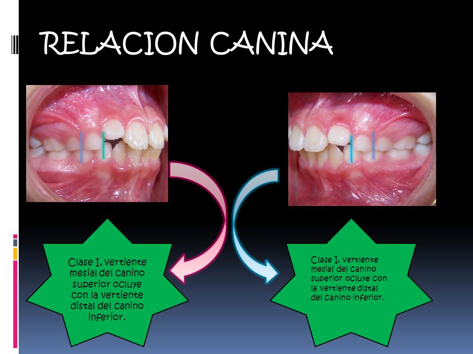 RELACION CANINA Clase I, vertiente mesial del canino superior ocluye con la vertiente distal del canino inferior.