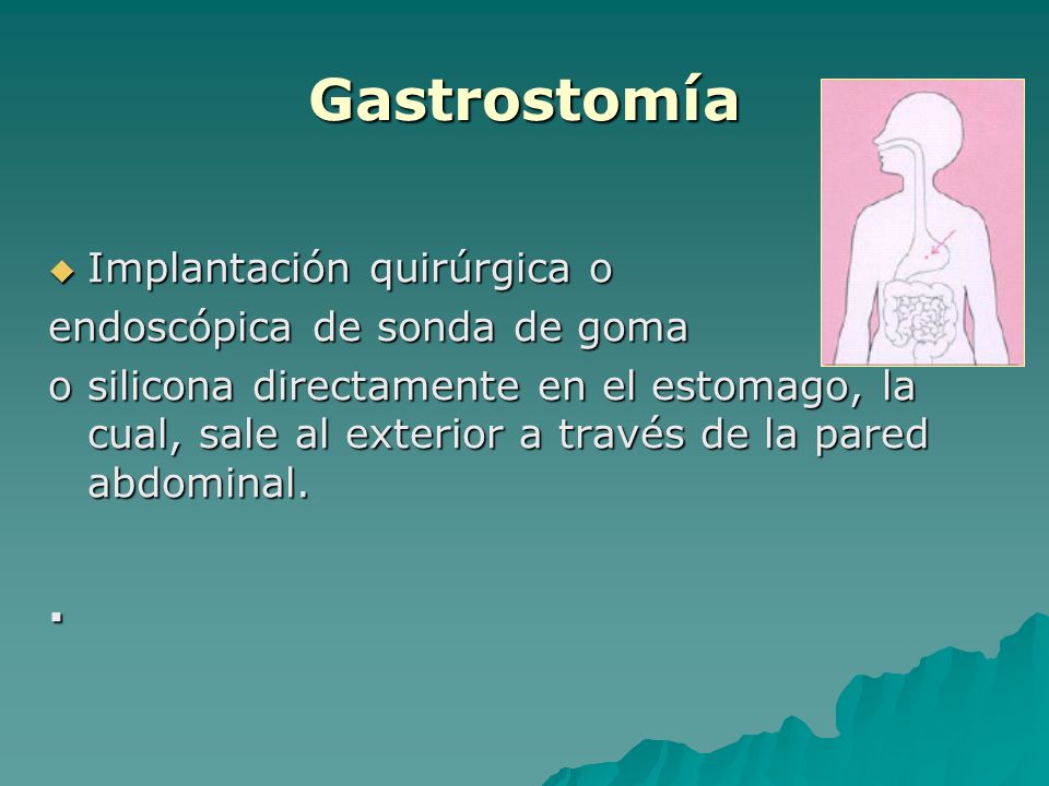Gastrostomía . Implantación quirúrgica o endoscópica de sonda de goma