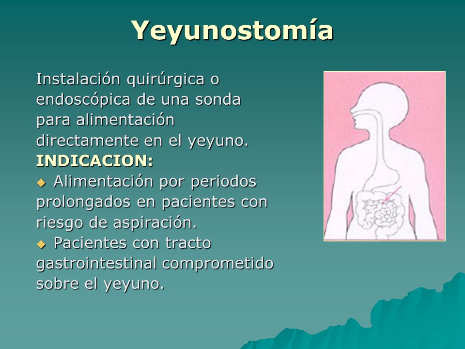 Yeyunostomía Instalación quirúrgica o endoscópica de una sonda