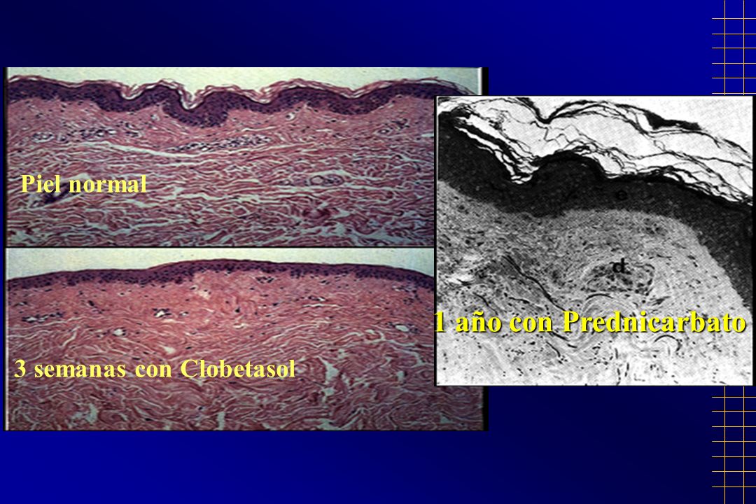 Piel normal 1 año con Prednicarbato 3 semanas con Clobetasol