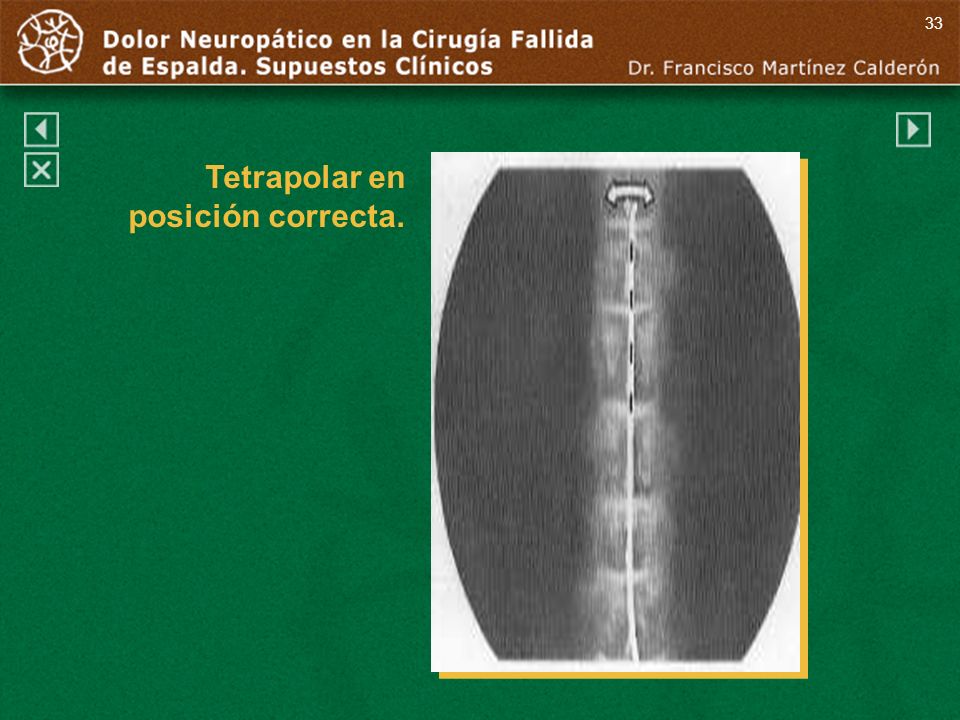 33 Tetrapolar en posición correcta. Tetrapolar en posición correcta.