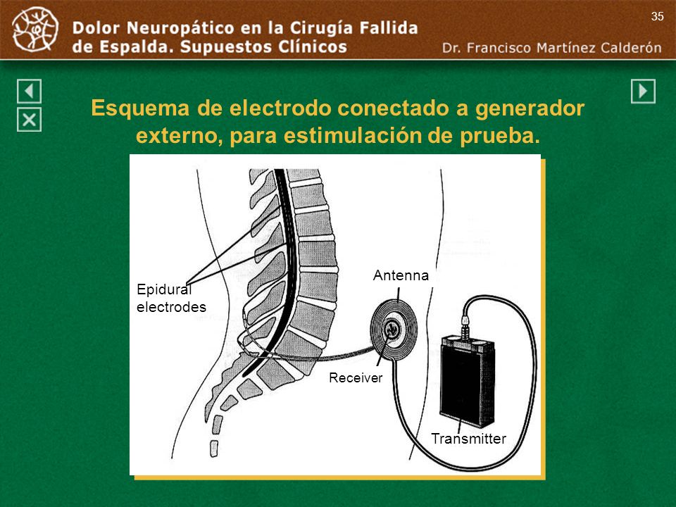 35 Esquema de electrodo conectado a generador externo, para estimulación de prueba. Antenna. Epidural.