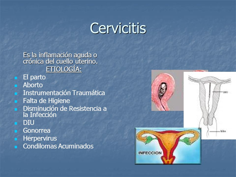 Cervicitis Es la inflamación aguda o crónica del cuello uterino.
