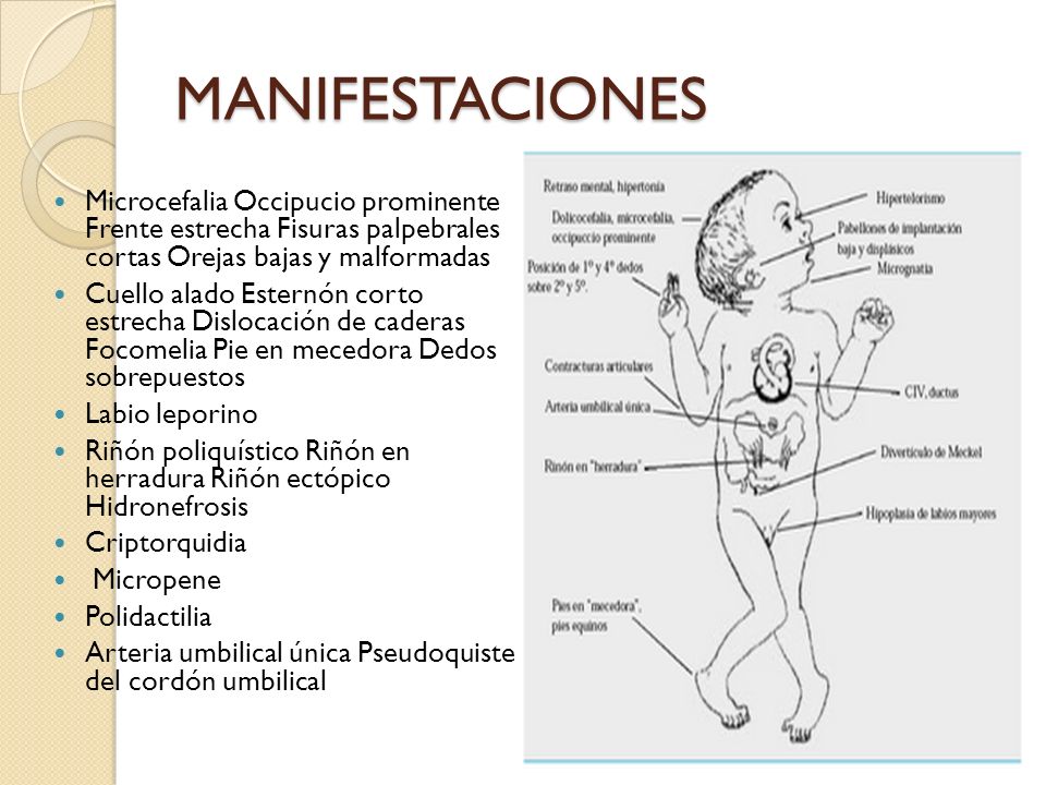 MANIFESTACIONES Microcefalia Occipucio prominente Frente estrecha Fisuras palpebrales cortas Orejas bajas y malformadas.