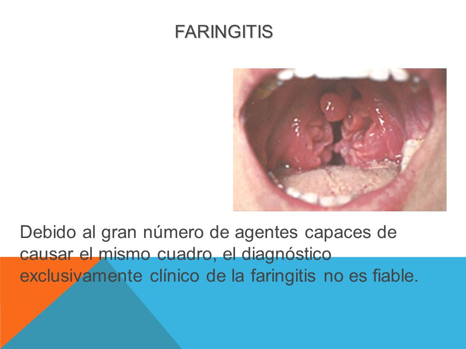 FARINGITIS Debido al gran número de agentes capaces de causar el mismo cuadro, el diagnóstico exclusivamente clínico de la faringitis no es fiable.