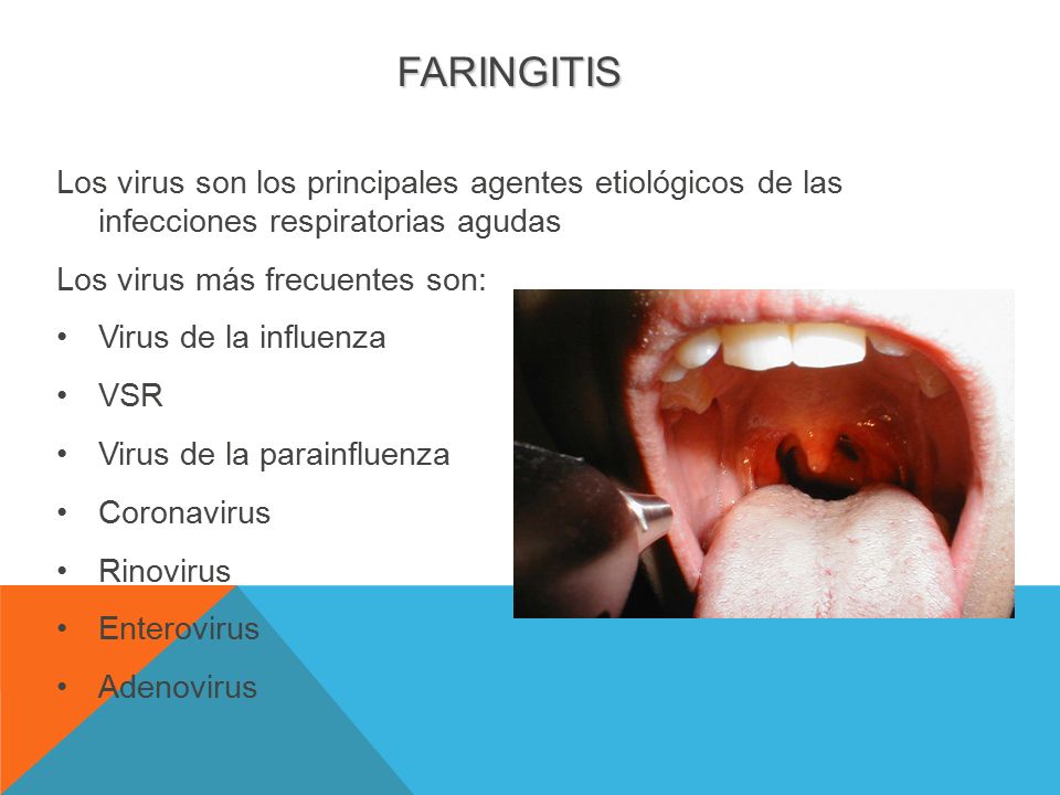 FARINGITIS Los virus son los principales agentes etiológicos de las infecciones respiratorias agudas.