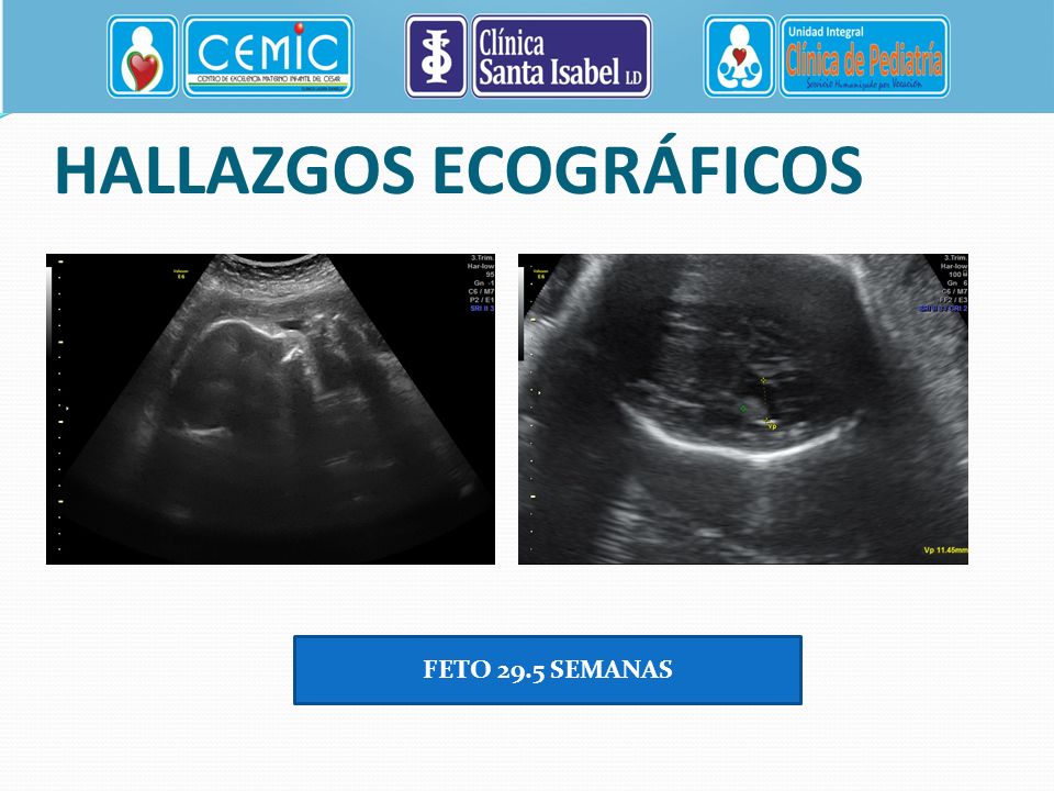 HALLAZGOS ECOGRÁFICOS